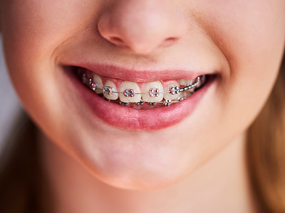 Alt text   A young person with a radiant smile, wearing braces and showcasing their well-maintained teeth.