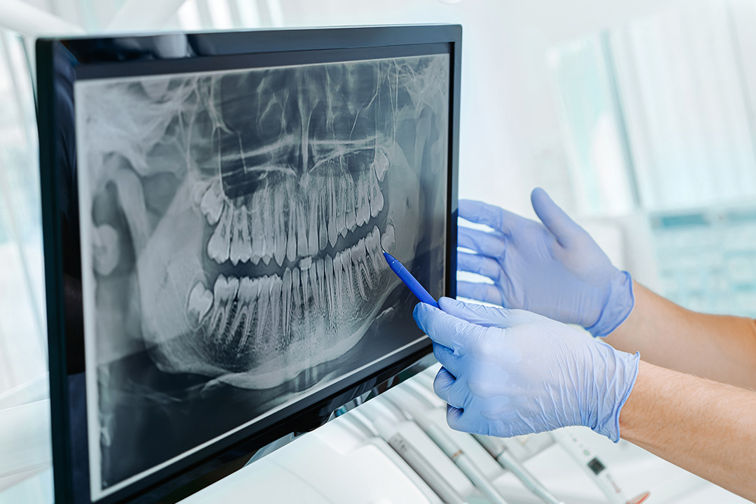 A dental professional examines a patient s X-ray, with the image displayed on a computer monitor.