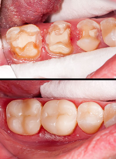 The image shows a close-up of a person s mouth with several missing teeth and visible decay, accompanied by a before-and-after comparison of the same mouth after dental treatment.