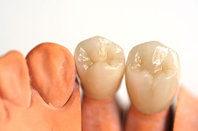 The image displays a close-up of two artificial teeth with visible root structures, placed next to each other against a plain background.