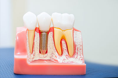 The image shows a model of a human mouth with artificial teeth and gums, featuring dental implants and screws.