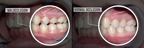 The image shows a close-up of a person s mouth with teeth, before and after dental treatment.