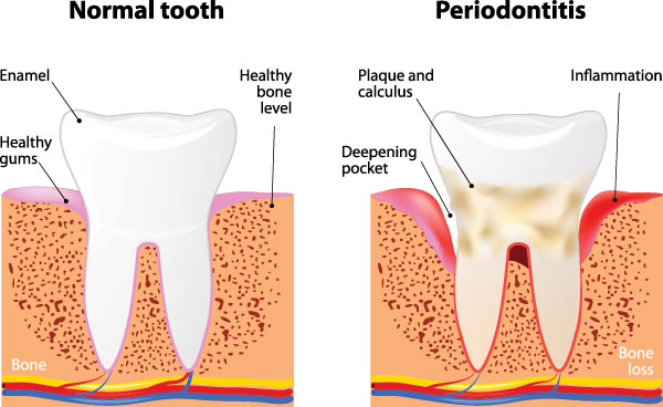 The image is a medical illustration showing the progression of tooth decay from normal to periodontitis, highlighting the stages with labels such as  healthy gum,   bone loss,  and  periodontal pocket.