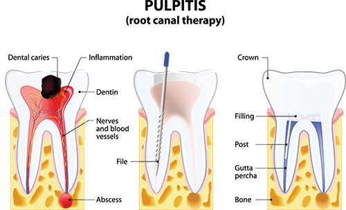 The image is an educational diagram illustrating the process of pulpitis, a dental condition where the pulp of a tooth becomes inflamed. It depicts the anatomy of a tooth with labels pointing to different parts of the tooth s structure, including the dentin, nerve, and pulp chamber. A blue arrow indicates the direction of heat or irritation that causes pulpitis, and there are visual representations of various stages of the condition, such as inflammation and infection. The image also includes a caption explaining what pulpitis is.