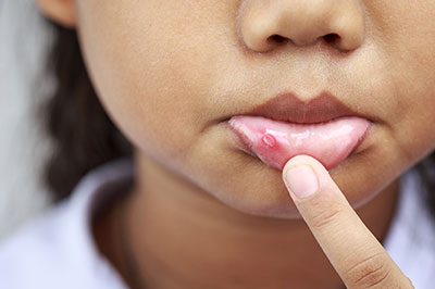 A young child with a small blemish on their face, pointing at it.