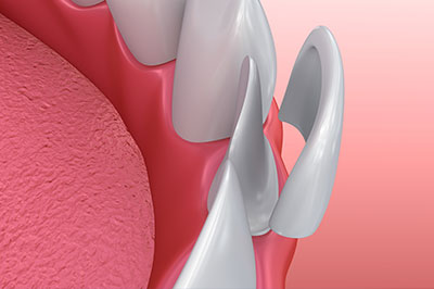 An image of a dental implant with multiple spikes on its surface, set against a pink background that resembles gum tissue.