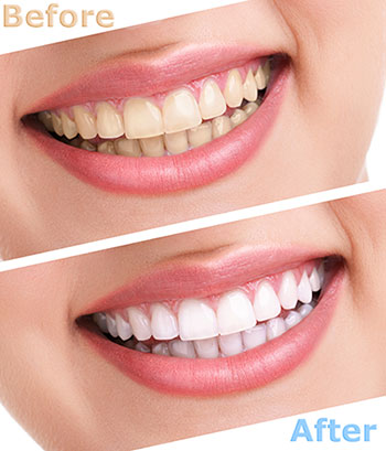 The image shows a side-by-side comparison of a person s teeth before and after a dental treatment, with the  before  showing stained teeth and the  after  displaying clean, white teeth.