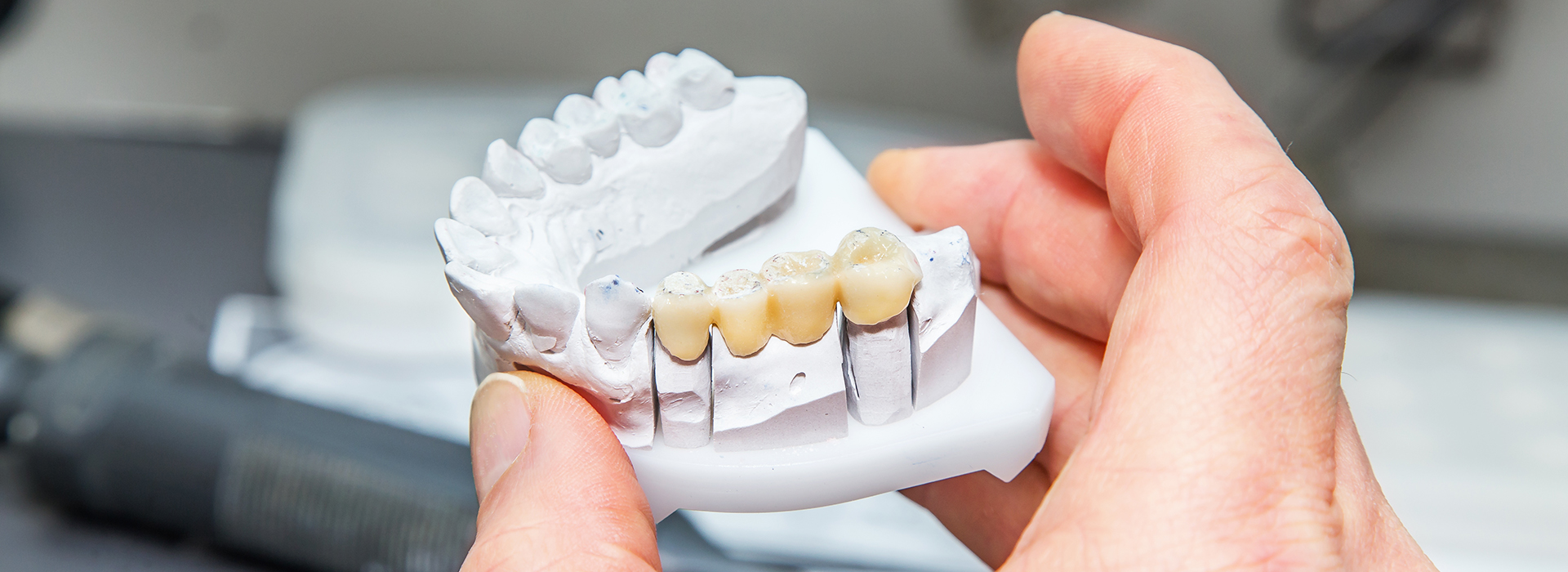 An individual is holding a dental implant, which appears to be a white ceramic or porcelain piece with multiple teeth-like structures.