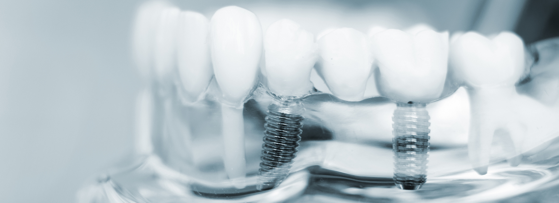 The image is a close-up photograph of a set of teeth, possibly taken from an angle to show the back side of the teeth, with visible dental implants and what appears to be clear plastic retainers or aligners.