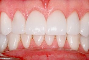 The image shows a close-up of a person s teeth with a focus on the front teeth, which appear to be in need of dental care due to discoloration and possible decay.