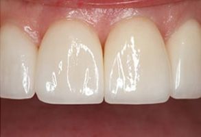 The image shows a close-up of a person s teeth, featuring a set of white porcelain veneers with natural-looking edges and a smooth, glossy finish.