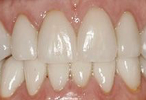 The image shows a close-up of someone s teeth with a focus on the front teeth, which appear to be in need of dental care due to discoloration and potential decay.